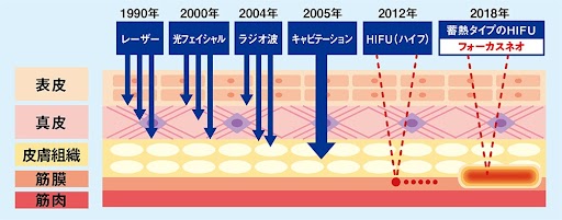 従来のハイフを超えた蓄熱式超音波！